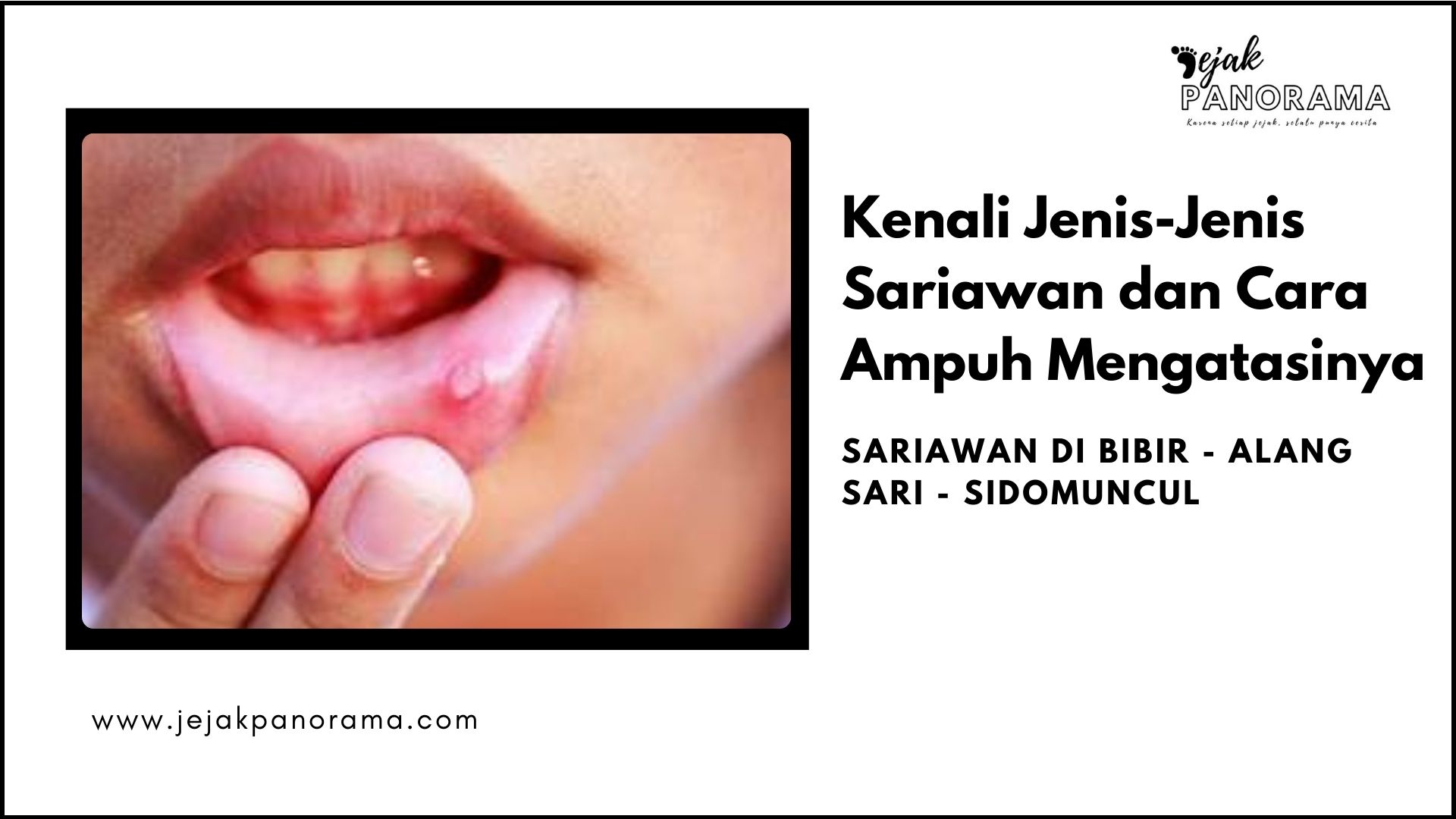 jenis jenis sariawan